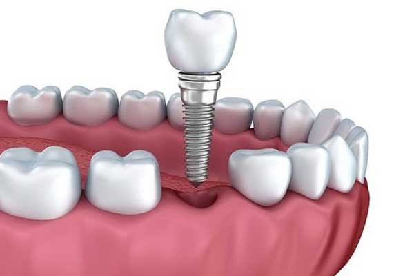 implantes dentales opiniones