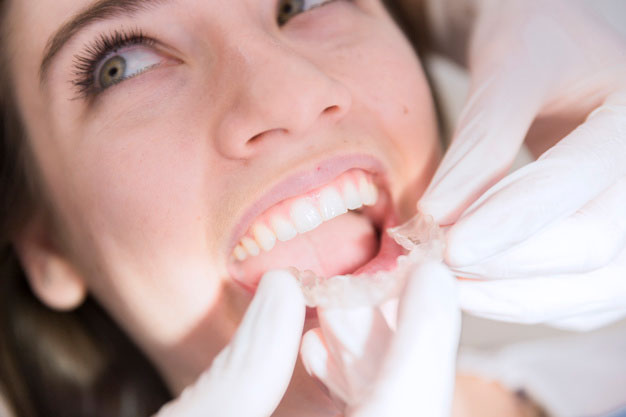 ¿Es compatible la ortodoncia con los implantes?